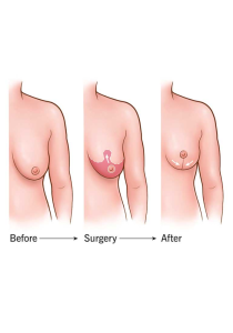 لیفت سینه (ماستوپکسی)