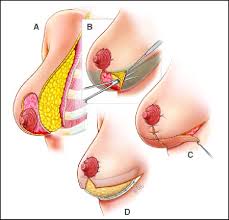 لیفت سینه (ماستوپکسی)
