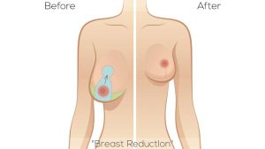 لیفت سینه (ماستوپکسی)