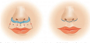 لیفت سانترال لب (Central Lip Lift)