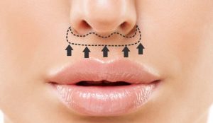 لیفت سانترال لب (Central Lip Lift)