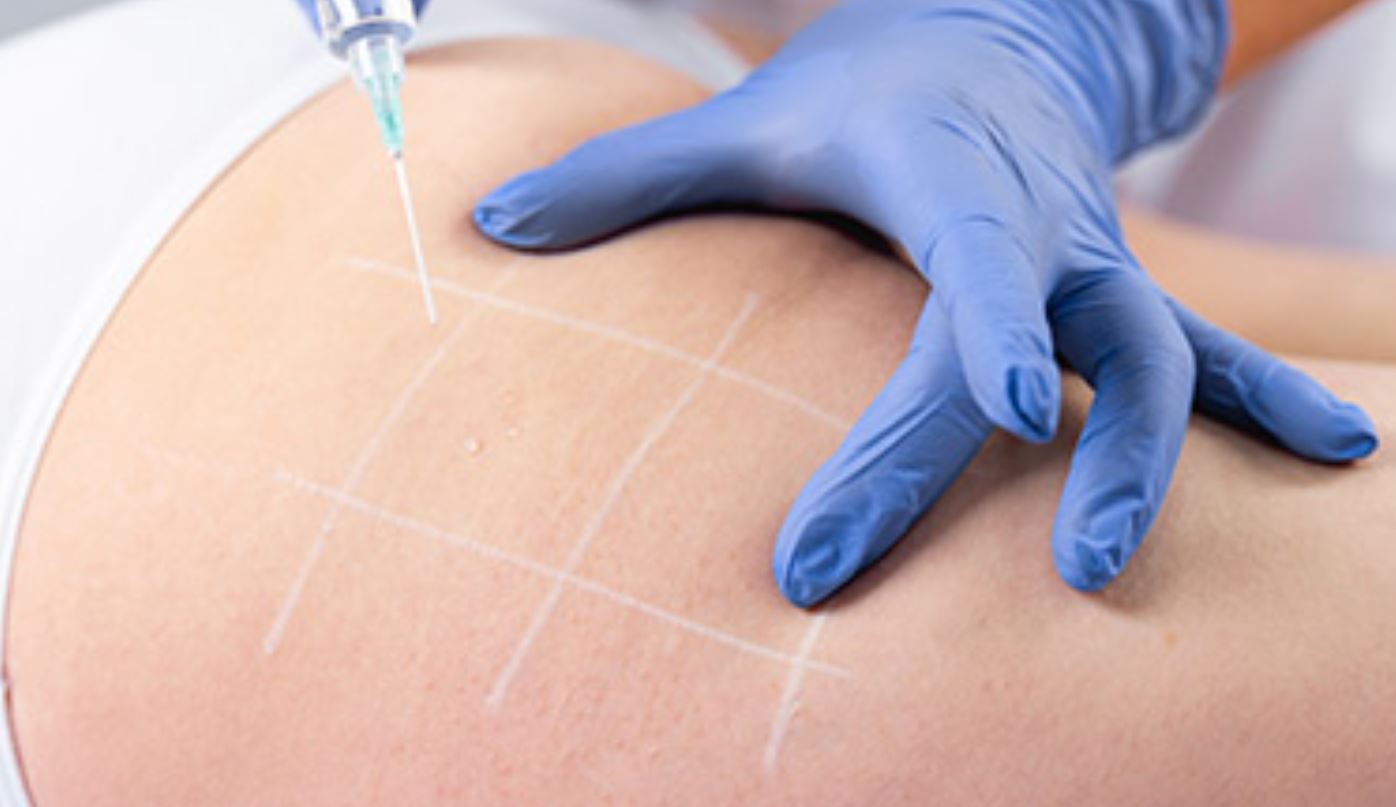 تزریق ژل به ران برای داشتن پاهای خوش فرم