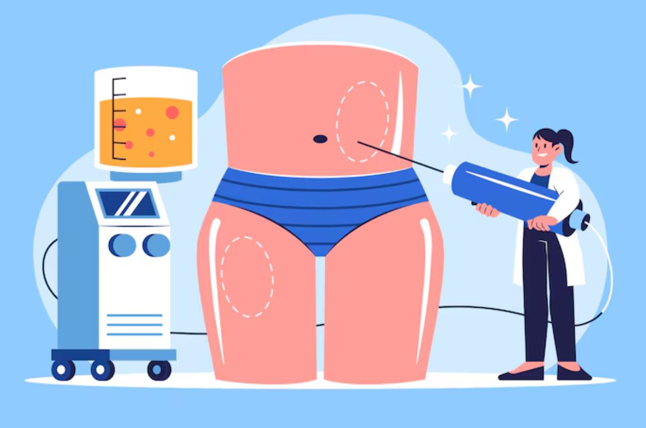 کبودی بعد از فیلر بادی