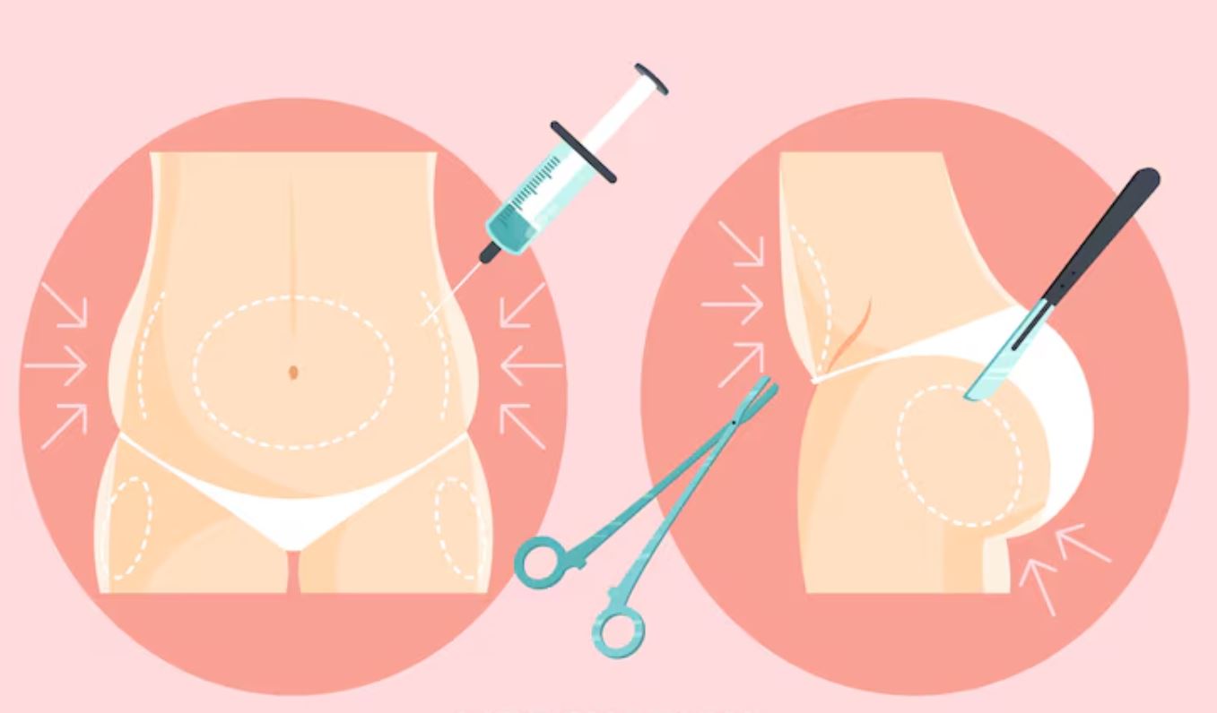 دوران نقاهت بعد از فیلر بادی